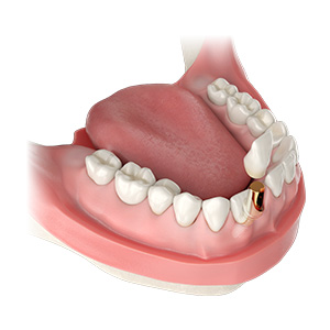 Anterior Implant Esthetics