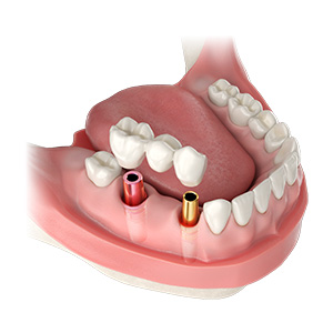 Beyond Implant Essentials