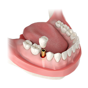 Implant Essentials